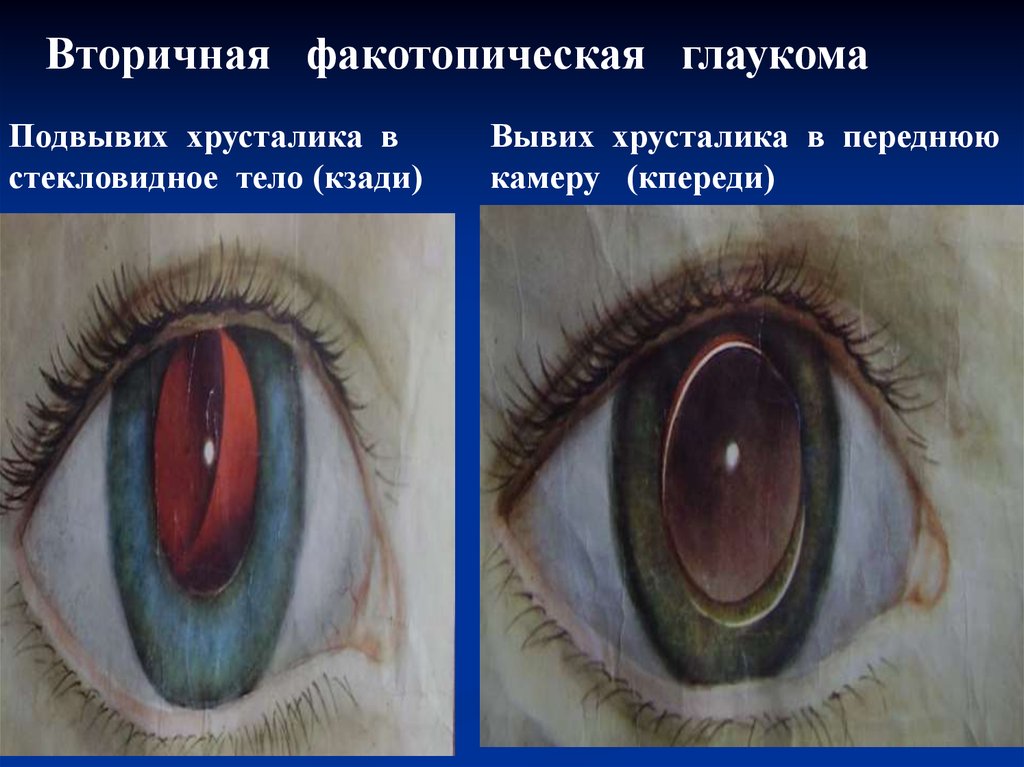 Глаукома латынь. Вторичная глаукома этиология. Травматическая глаукома. Осложненная катаракта сублюксация хрусталика. Дифференциальный диагноз а) подвывих хрусталика.