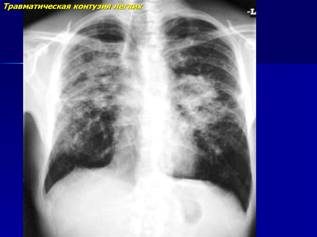Разрыв легочной. Контузия легких рентген. Травматическое поражение легких.