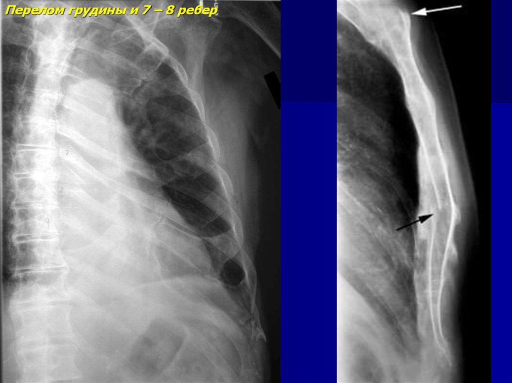 Перелом грудины. Перелом рукоятки грудины рентген. Перелом мечевидного отростка грудины. Перелом мечевидного отростка рентген. Перелом грудины со смещением рентген.