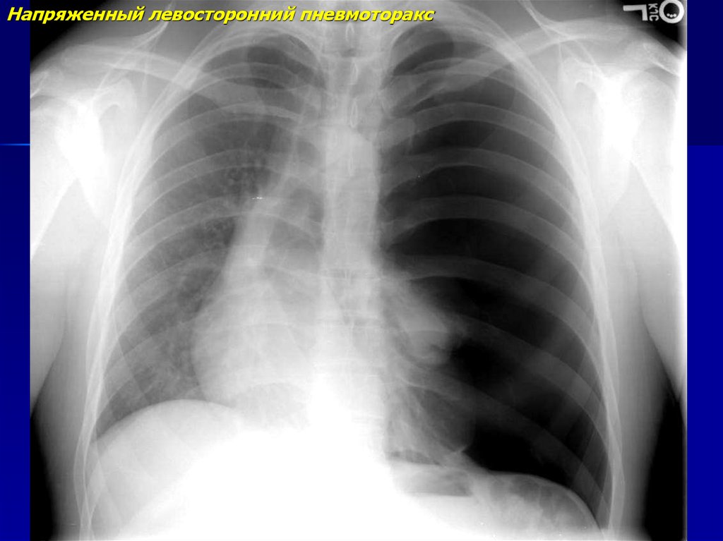 Напряженный пневмоторакс. Пневмоторакс рентген. Клапанный напряженный пневмоторакс рентген. Клапанный пневмоторакс рентгенограмма. Пристеночный пневмоторакс рентген.