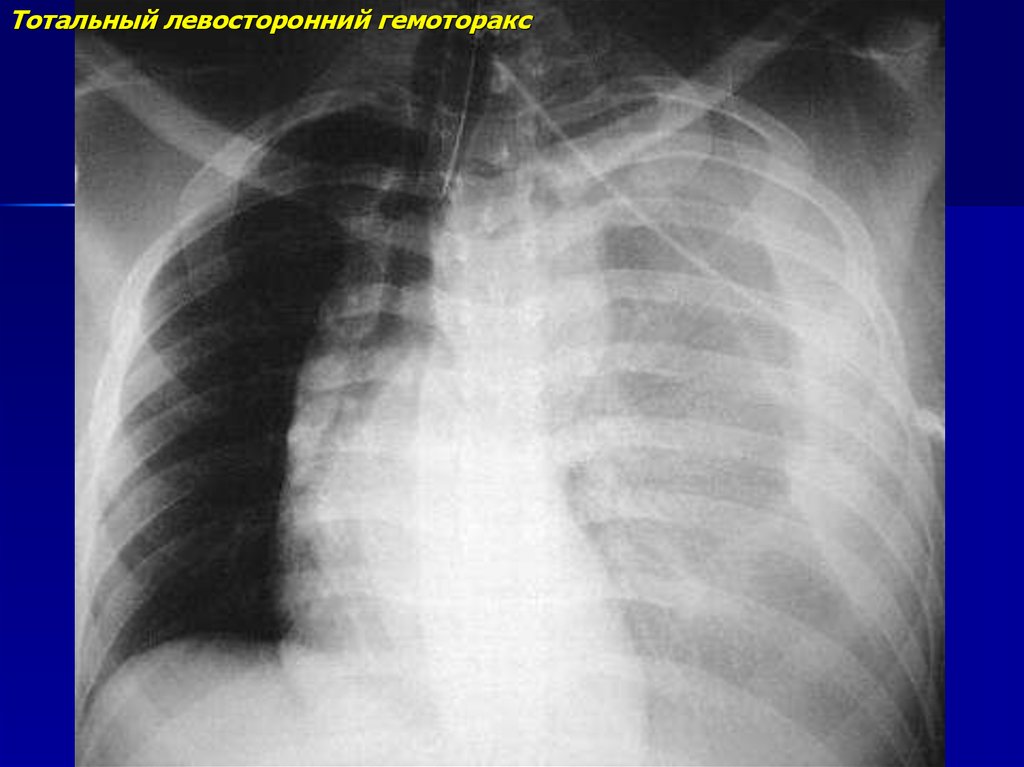 Лучевые признаки гидроторакса гемоторакса рентгеновская картина