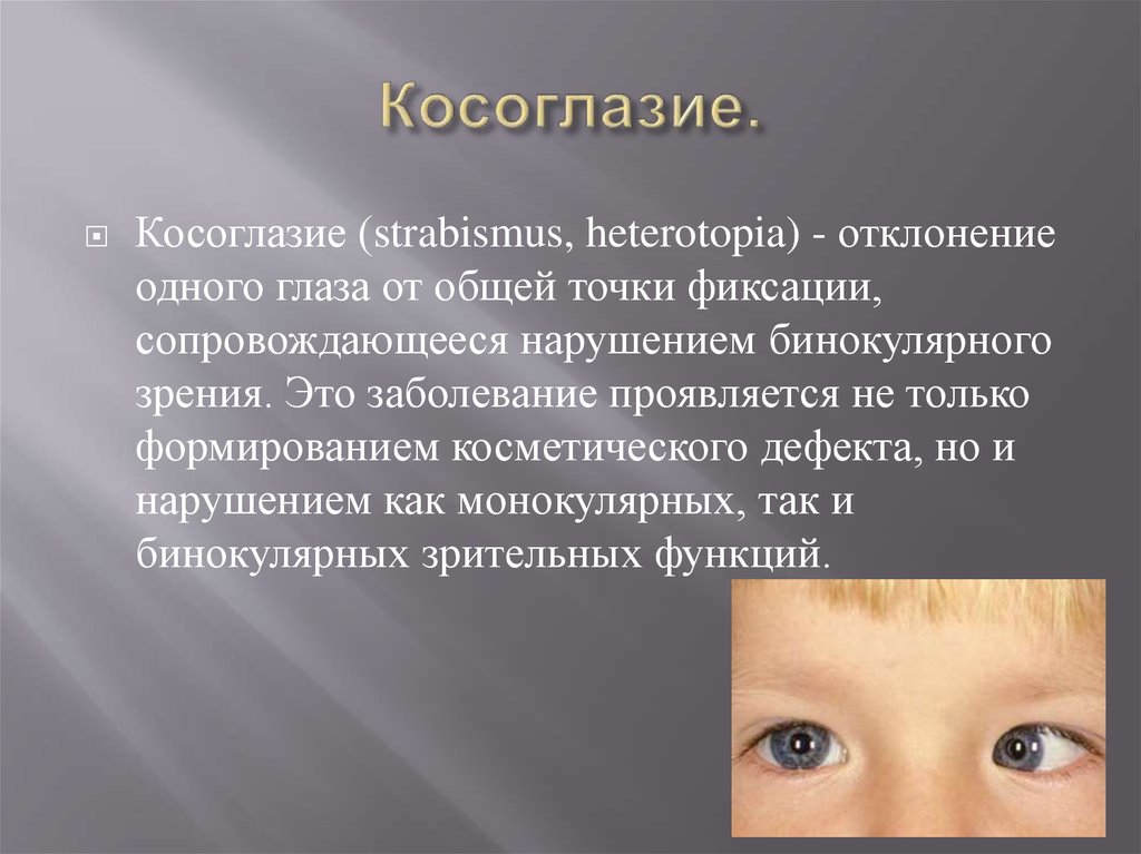 Косоглазие симптомы. Косоглазие. Заболевания косоглазие. Болезни глаз косоглазие. Нарушение зрения косоглазие.