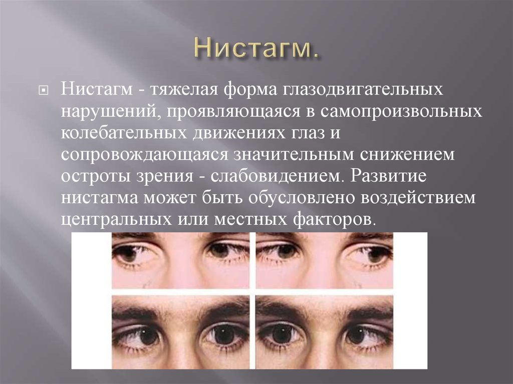 Зрение двумя глазами называют. Нистагм. Горизонтальный нистагм. Горизонтальный глазной нистагм. Спонтанный горизонтальный нистагм.