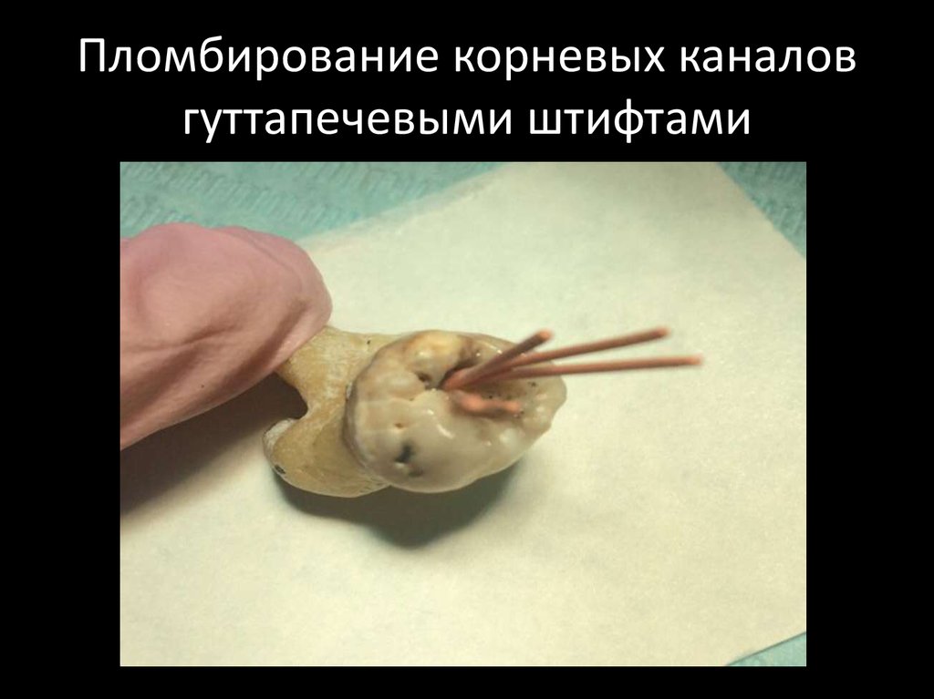 Пломбирование корневых каналов гуттапечевыми штифтами