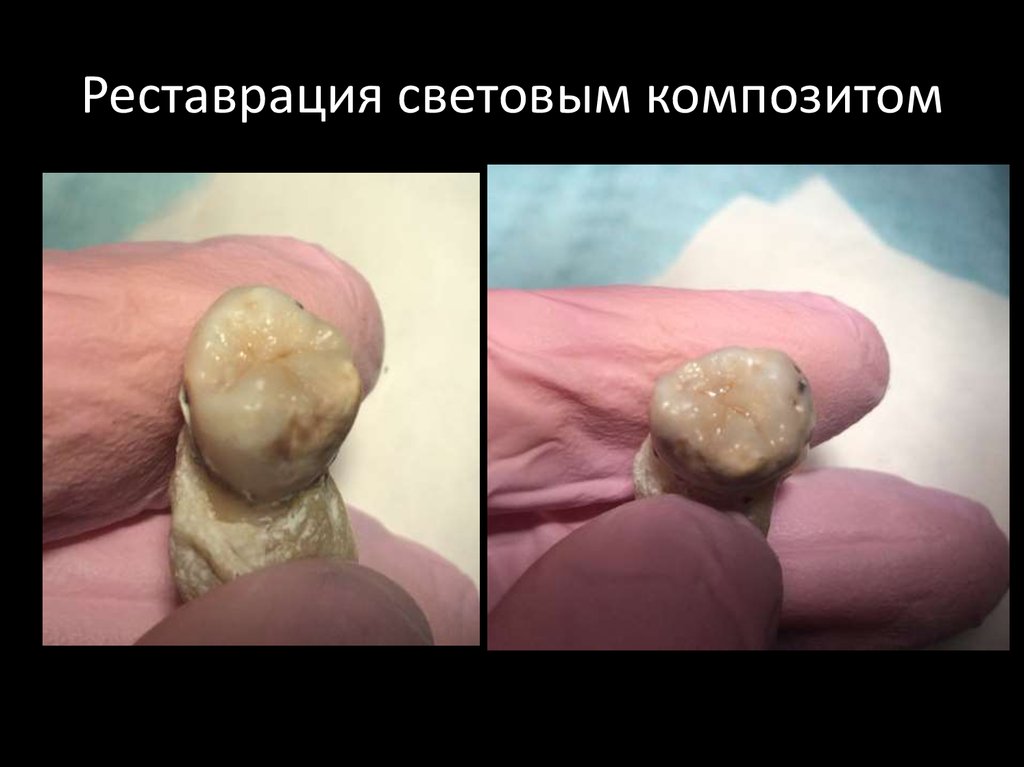 Реставрация световым композитом