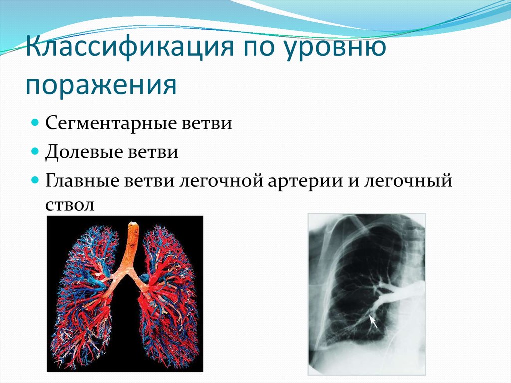 Тромбоэмболия легочной артерии код мкб