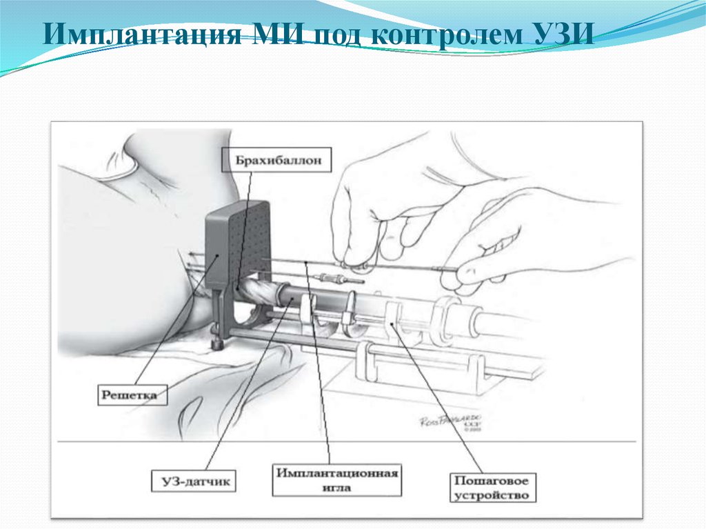 Под контролем узи. Брахитерапия простаты УЗИ. Аппарат брахитерапии чертеж.