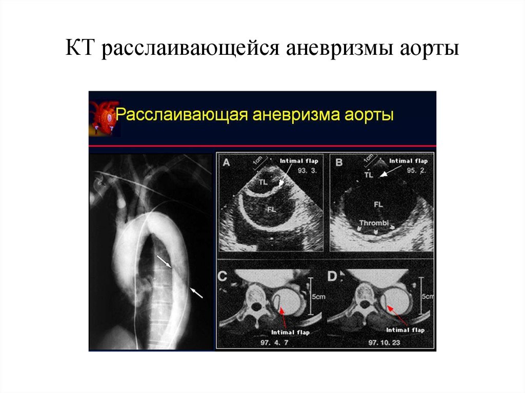 Расслаивающаяся аневризма аорты презентация