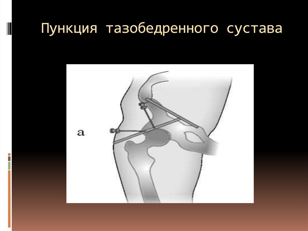 Бедренная пункция. Пункция коленного и тазобедренного суставов. Точки пункции коленного сустава. Пункция коленного сустава точки пункции.