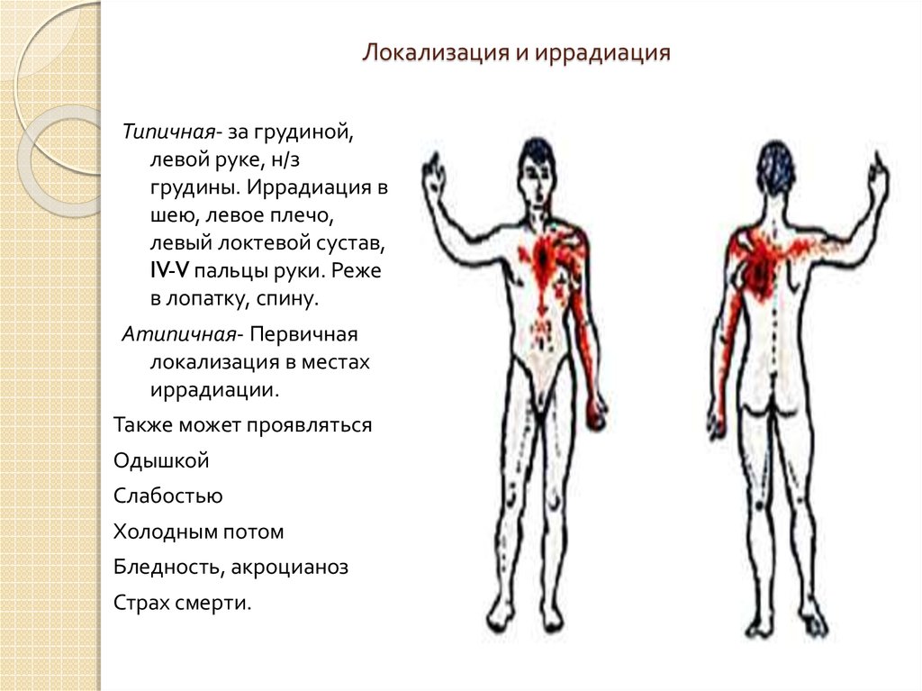 Иррадиация боли при стенокардии