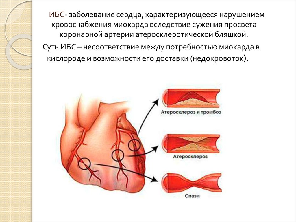 Поражения коронарных сосудов. Ишемическая болезнь сердца причины. Причины уменьшения коронарного кровотока. Атеросклероз коронарных артерий. Ишемическая кардиомиопатия.