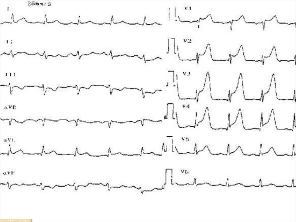 Трансмуральный инфаркт миокарда. Острый трансмуральный инфаркт миокарда ЭКГ. Трансмуральный инфаркт миокарда на ЭКГ. ЭКГ передне перегородочный инфаркт. Стадии трансмурального инфаркта миокарда на ЭКГ.