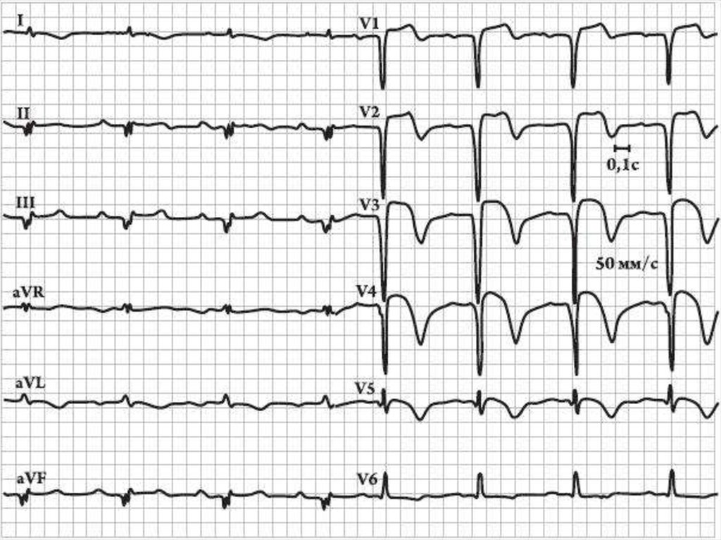 Патологический зубец q при инфаркте. Инфаркт миокарда с q-зубцом. Электрокардиограмма .. ЭКГ инфаркт миокарда, рубцовые изменения. Зубец q при инфаркте миокарда на ЭКГ. Патологический зубец q на ЭКГ при инфаркте миокарда.