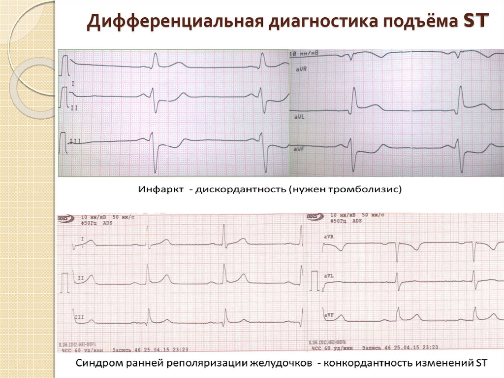 Реполяризации диффузного характера. Ранняя реполяризация желудочков на ЭКГ. Изменение реполяризации на ЭКГ. Ранняя реполяризация желудочков сердца на ЭКГ. СРРЖ на ЭКГ.