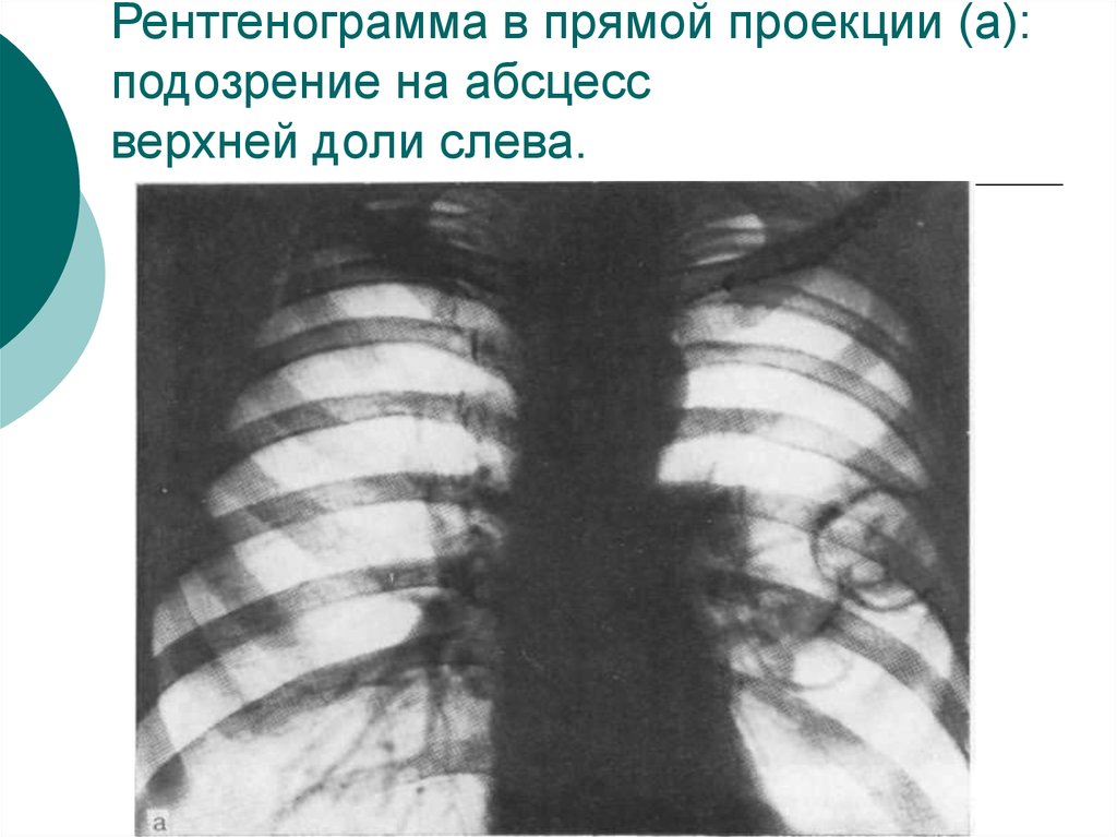 Периферический рак верхней доли. Рентгенограмма в прямой проекции. Абсцесс легкого верхней доли. Абсцесс в верхней доле левого легкого. Абсцесс верхней доли лёгкого.