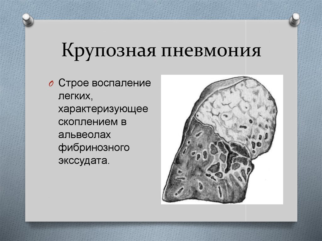 Крупозная пневмония. Крупозная пневмония очаг поражения. Крупозное фибринозное воспаление. Крупозная пневмония заболевания.