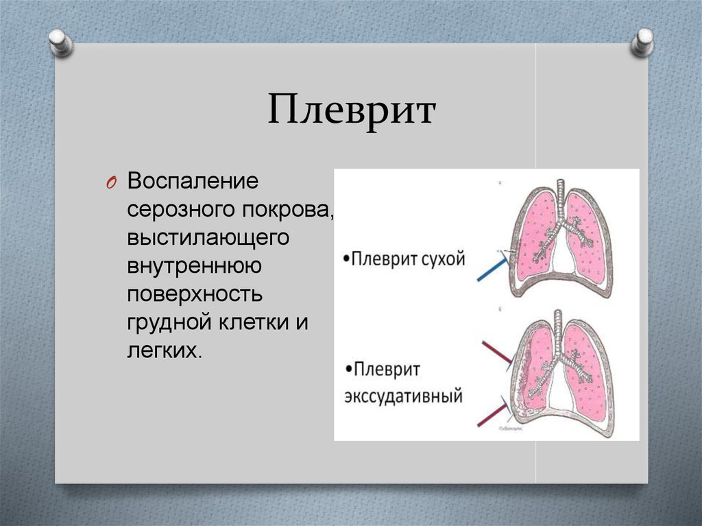 Плевральная полость картинки