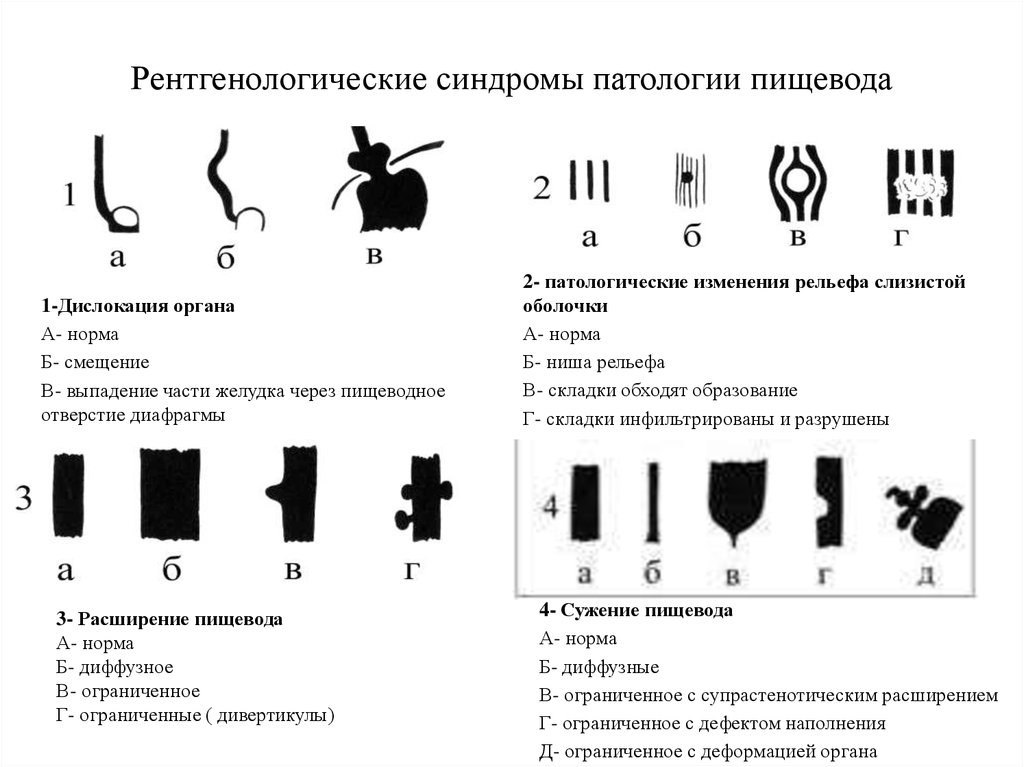 Синдром пищевода. Основные рентгенологические синдромы заболеваний ЖКТ. Основные рентгенологические синдромы патологии пищевода. Синдромы заболеваний ЖКТ лучевая диагностика.