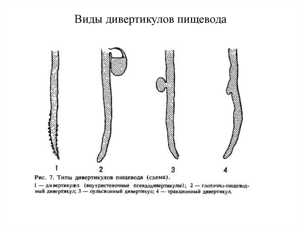 Дивертикулит пищевода