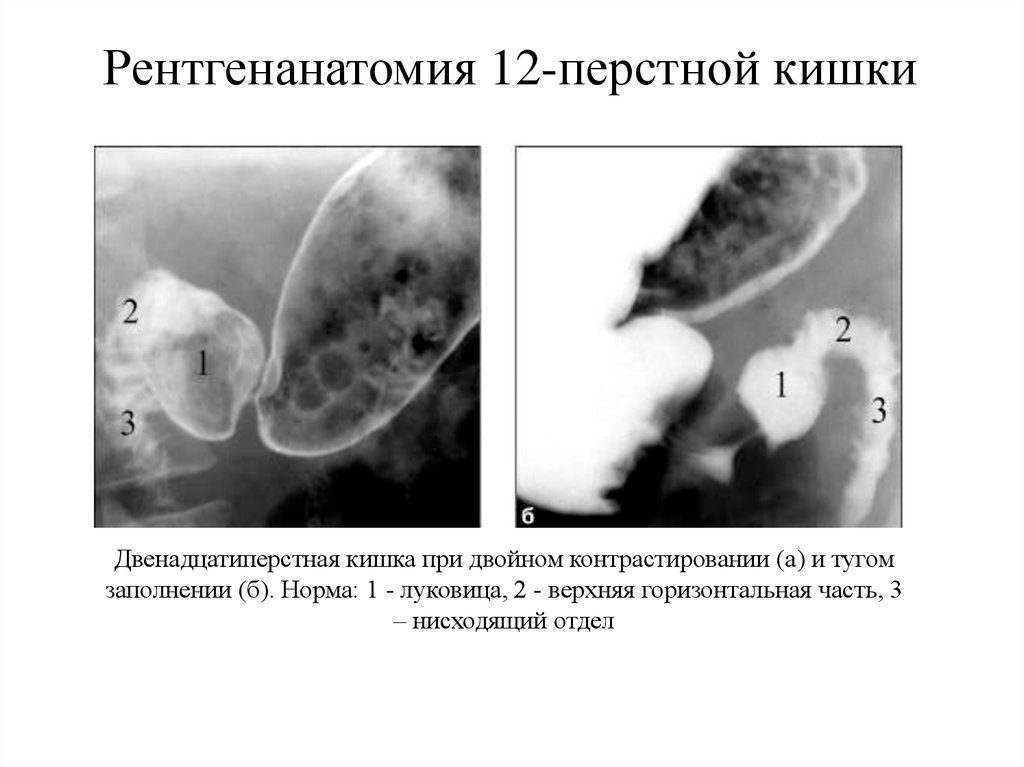 Рентгеноскопия двенадцатиперстной кишки. Анатомия 12-ти перстной кишки рентген. Луковица двенадцатиперстной кишки рентген анатомия. Отделы желудка анатомия рентген. Луковица ДПК анатомия рентген.