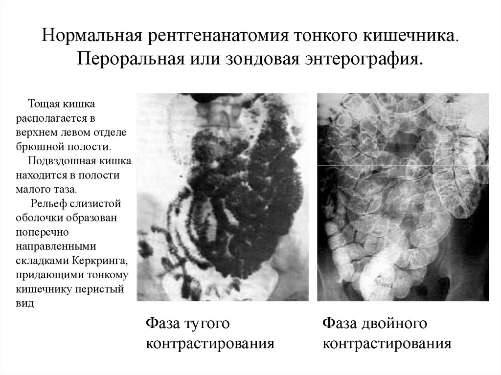 Нормальная рентгенанатомия тонкого кишечника. Пероральная или зондовая энтерография.