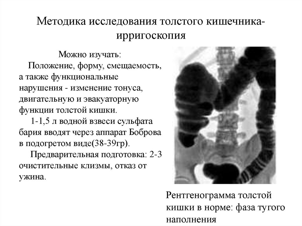 Кт ирригоскопия кишечника