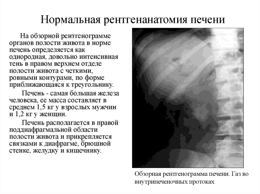 Полость нормально. Нормальная рентгеноанатомия печени. Обзорная рентгенография печени. Обзорная рентгенограмма печени норма.