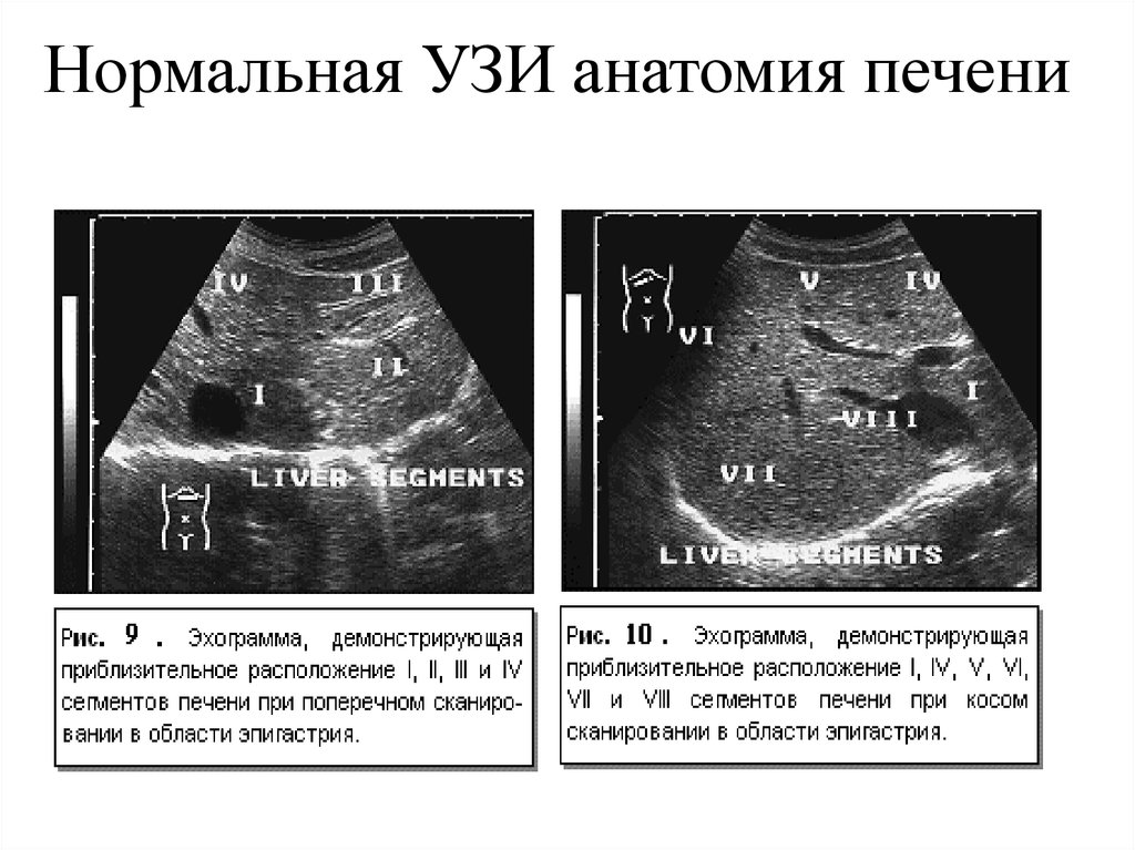 Сегменты печени на узи схема