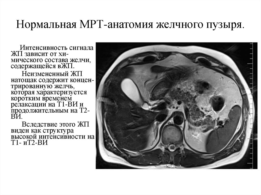 Седиментация в желчном. Кт анатомия желчных протоков. Конкременты желчного пузыря мрт.