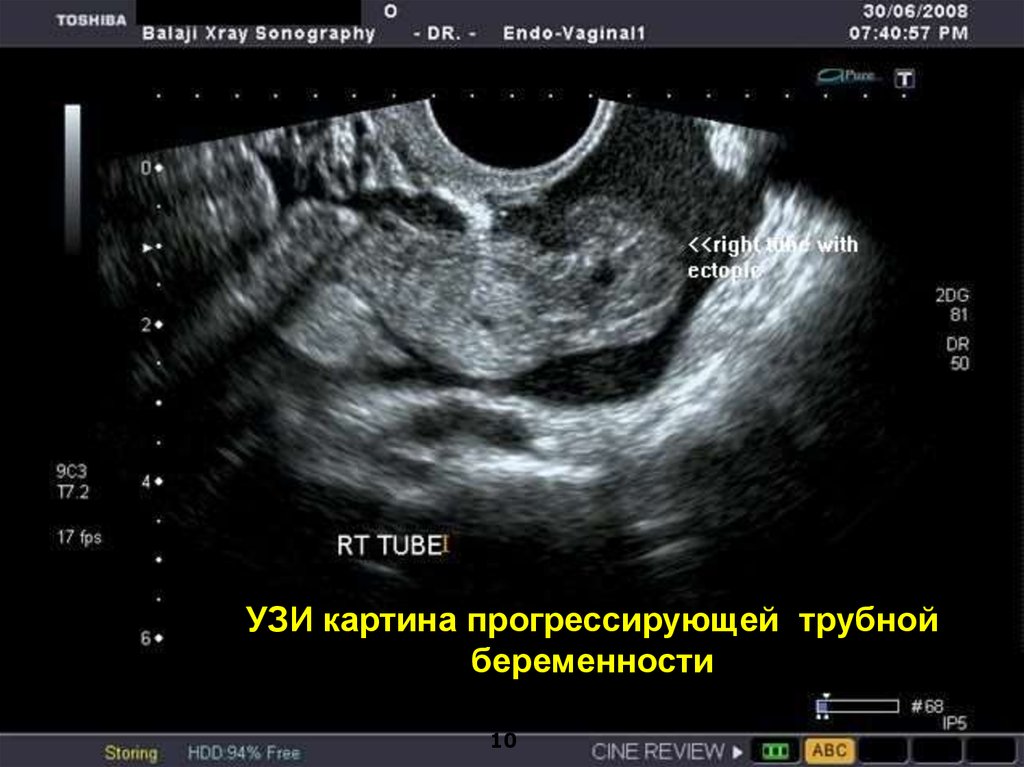 Когда на узи видно беременность на ранних. Внематочная Трубная беременность УЗИ. Эктопическая беременность УЗИ. УЗИ при трубной внематочной беременности. Эктопическая Трубная беременность.