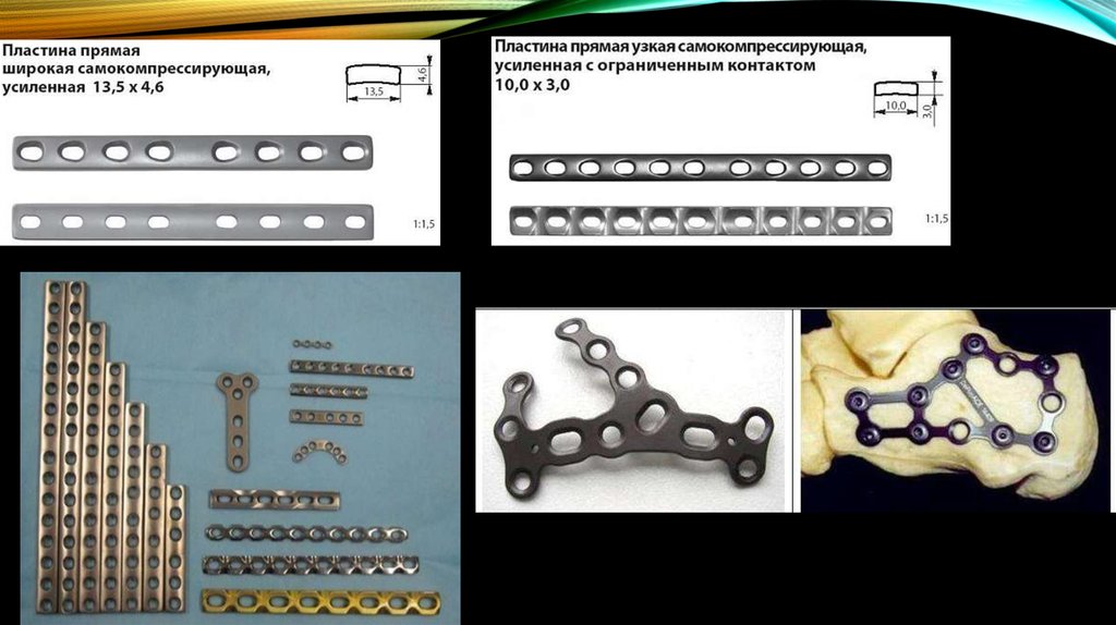 Виды пластин. Реконструктивная пластина остеосинтез. Классификация пластин для остеосинтеза. Накостный остеосинтез пластинами. Виды пластин для остеосинтеза в травматологии.
