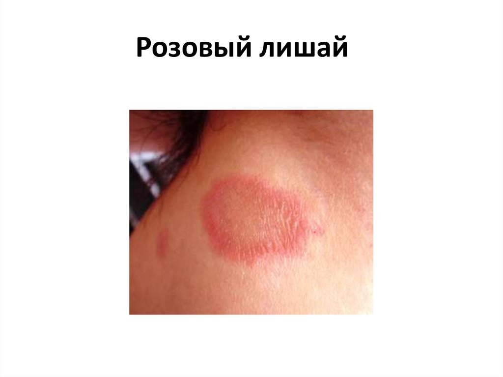 Розовый лишай