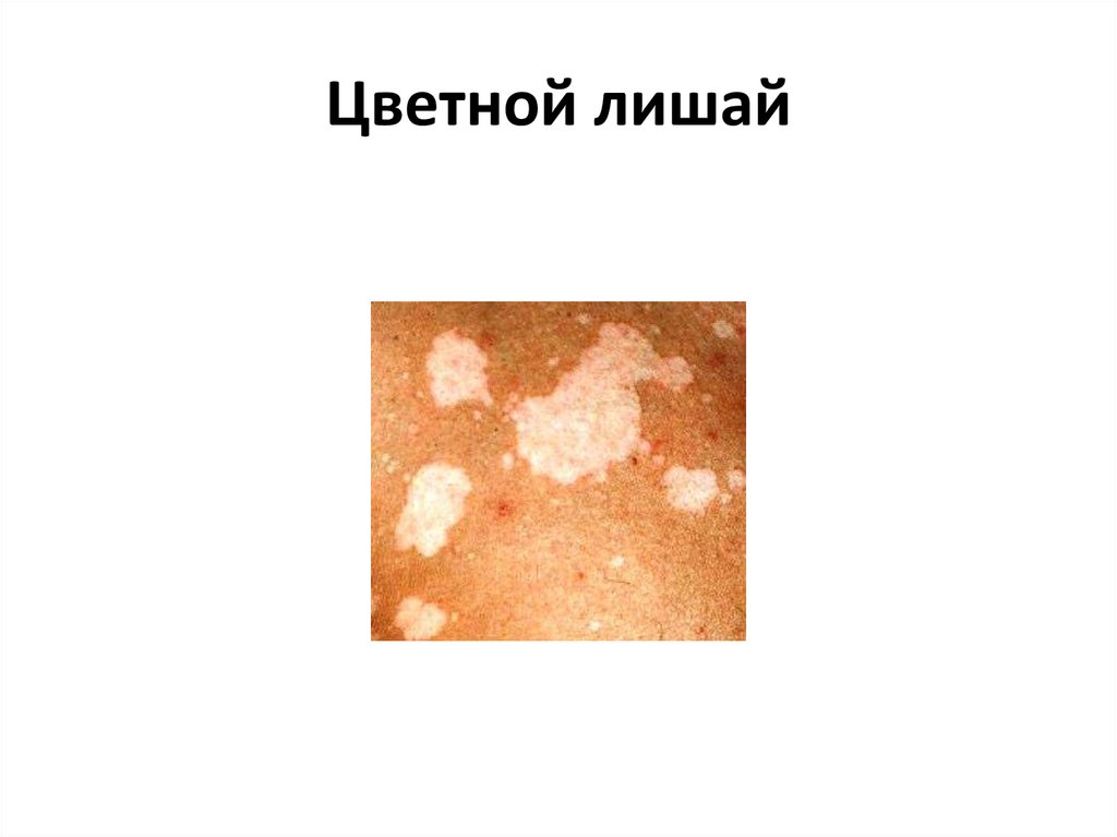 Цветной лишай