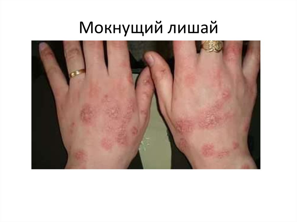 Мокнущий лишай