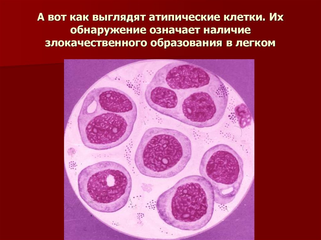 Атипичные клетки в цитологии что это. Атипические клетки исследование. Атипичные клетки в мокроте. Выявления атипичных клеток в мокроте.