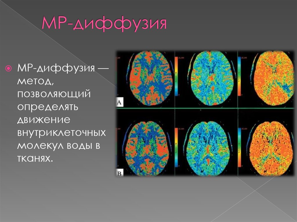 Диффузионно взвешенное изображение