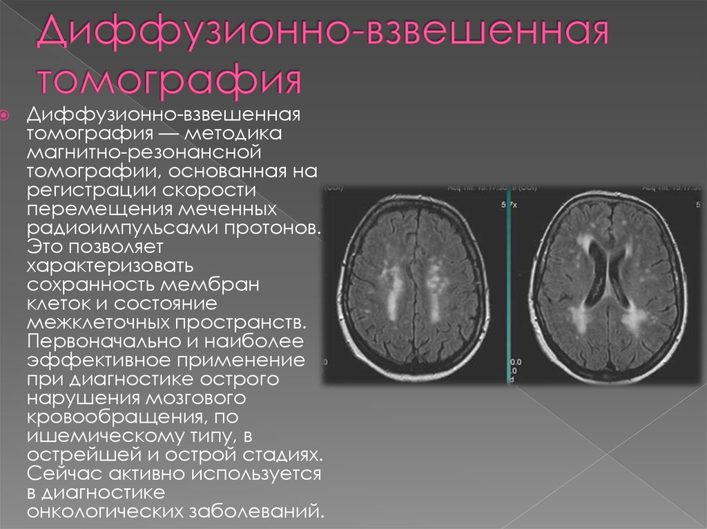 Диффузное обследование. Диффузионно взвешенное изображение мрт. Диффузионная мрт головного мозга. Диффузионная магнитно-резонансная томография. Магнитно-резонансная диффузия головного мозга.