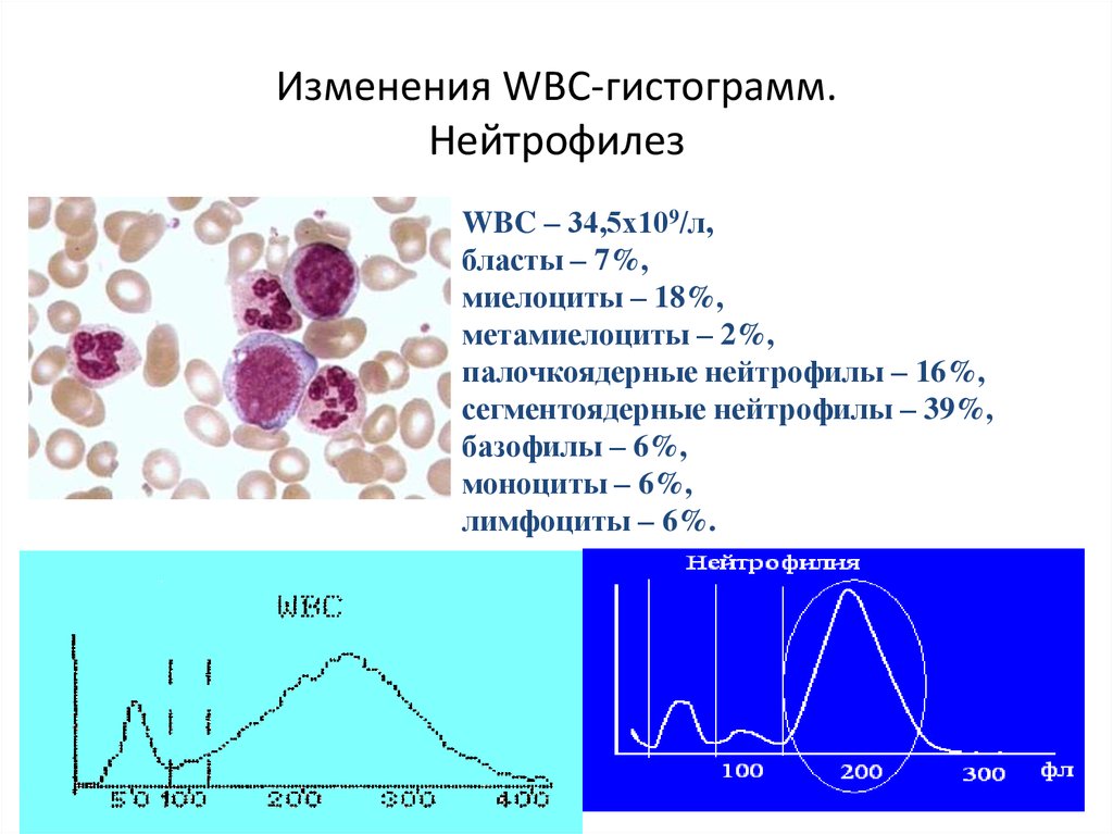 Нейтрофилез. Нейтрофилия характерна для. Нейтрофилез характерен для. Нейтрофилез возникает при.