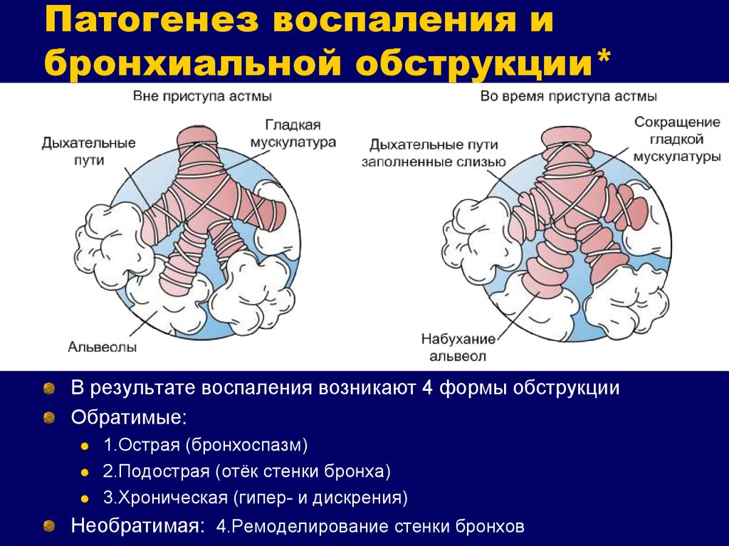 Патогенез бронхиальной обструкции. Патогенез воспаления и бронхиальной обструкции*. Механизм развития бронхиальной обструкции. Бронхиальная астма патофизиология.