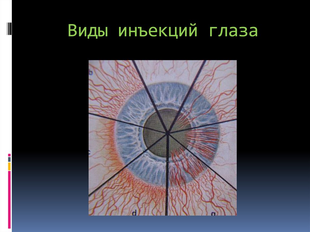 Укол в глаз. Застойная инъекция глазного яблока. Типы инъекции глазного яблока. Поверхностная инъекция глазного яблока. Внутриглазные инъекции.