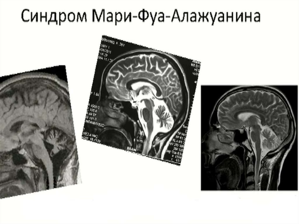 Синдром Мари-Фуа-Алажуанина - презентация онлайн