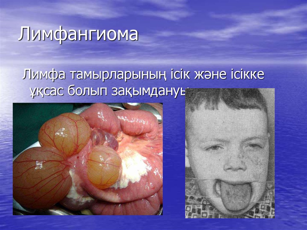 Лимфангиома