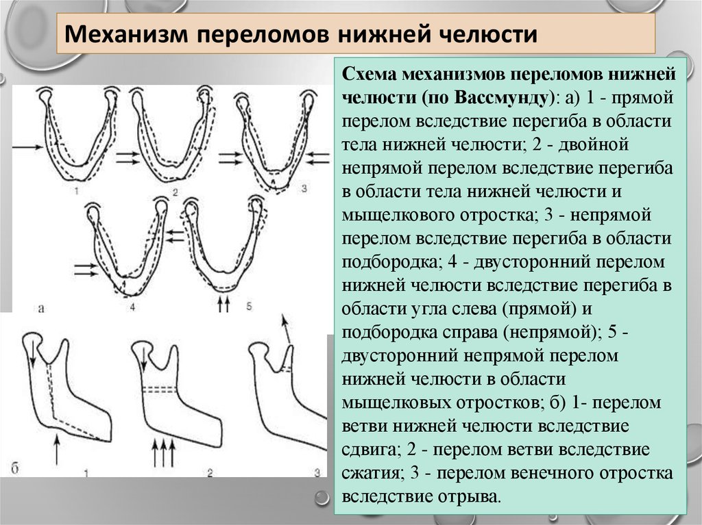 План лечения при переломе нижней челюсти