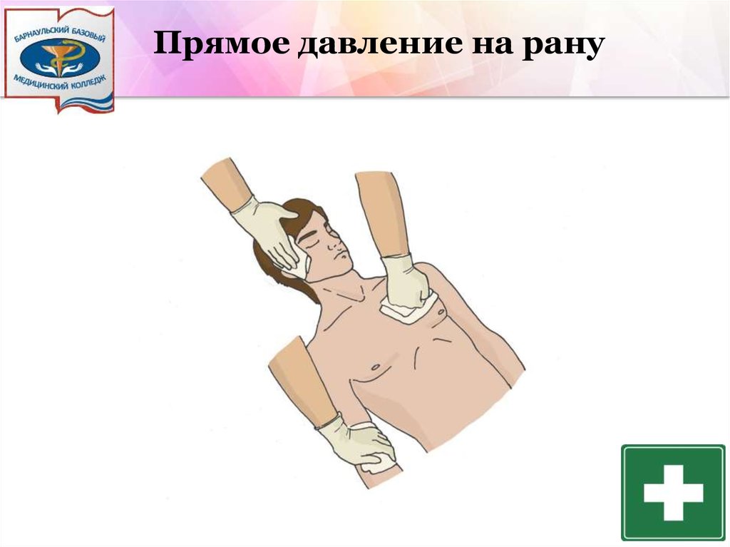 Давление на рану. Прямое давление на рану. Прямое давление на рано. Остановка кровотечения прямым давлением на рану. Прямое давление на рану при кровотечении.