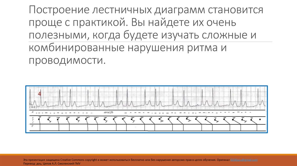 Стали просто. Лестничная диаграмма. Лестничная диаграмма ЭКГ.