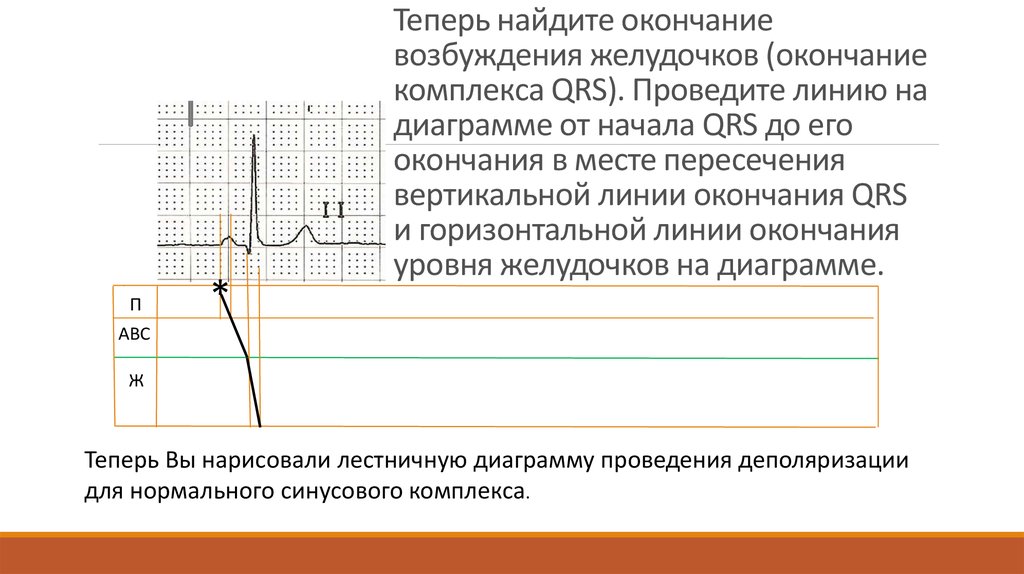 Синусовый ритм резкое отклонение влево