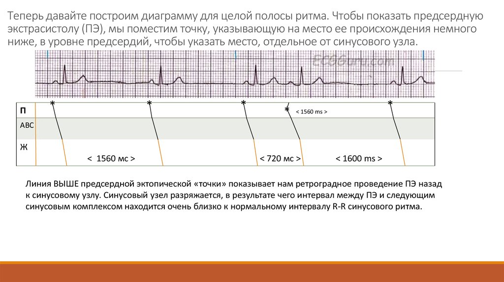 Теперь давайте построим диаграмму для целой полосы ритма. Чтобы показать предсердную экстрасистолу (ПЭ), мы поместим точку,