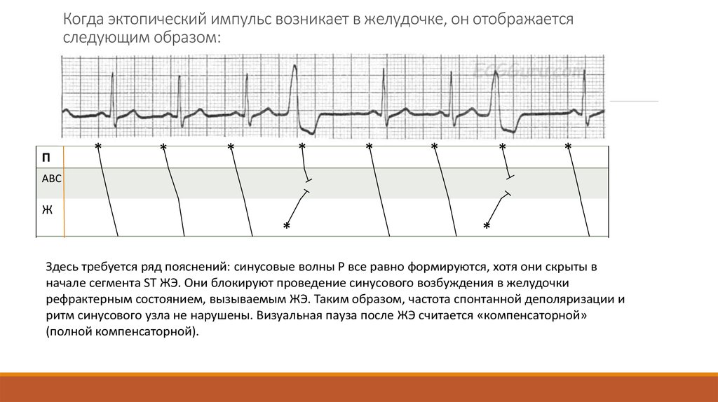 Эктопический это. Эктопический предсердный ритм. Эктопическая активность сердца что это такое. Эктопическом образовании импульса в желудочках.