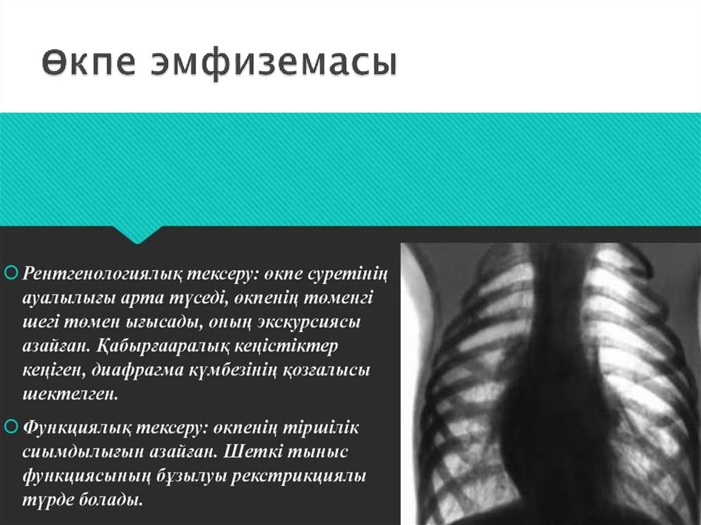 Өкпе эмфиземасы