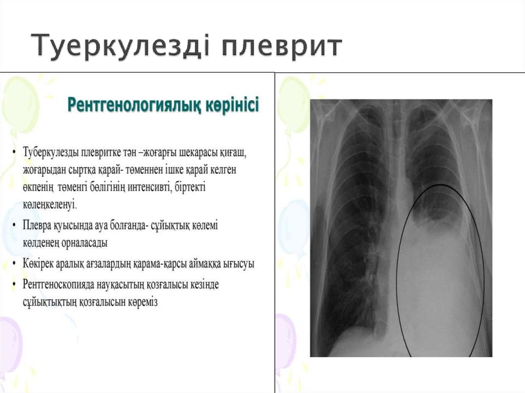 Питание при плеврите легкого картинки